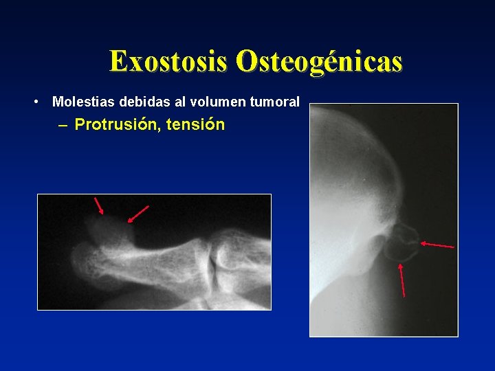 Exostosis Osteogénicas • Molestias debidas al volumen tumoral – Protrusión, tensión 