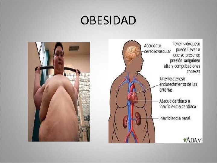 OBESIDAD 