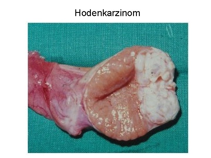 Hodenkarzinom 