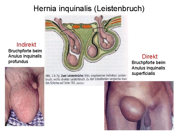 Hernia inquinalis (Leistenbruch) Indirekt Bruchpforte beim Anulus inquinalis profundus Direkt Bruchpforte beim Anulus inquinalis