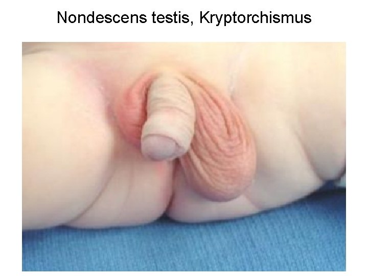 Nondescens testis, Kryptorchismus 