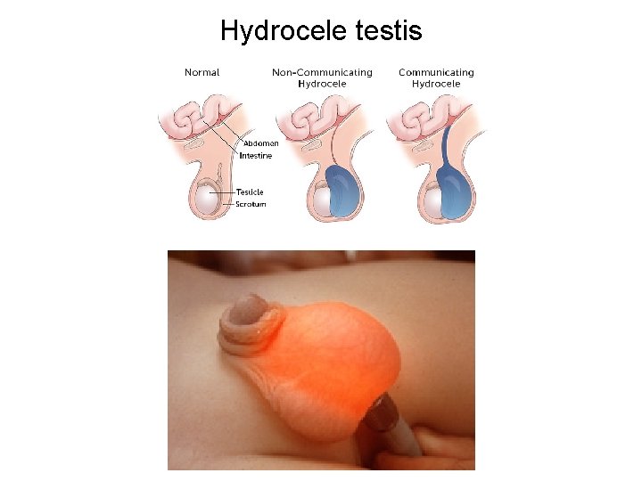 Hydrocele testis 