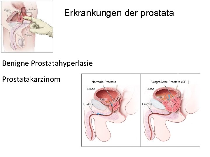 Erkrankungen der prostata Benigne Prostatahyperlasie Prostatakarzinom 