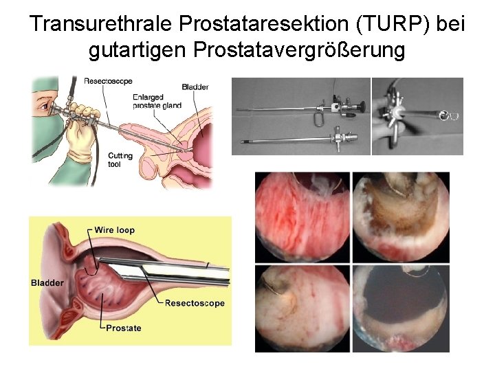 Transurethrale Prostataresektion (TURP) bei gutartigen Prostatavergrößerung 