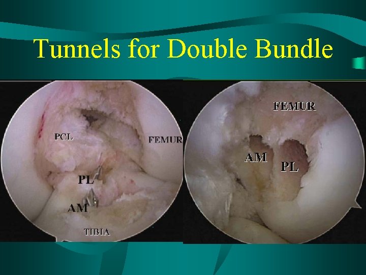 Tunnels for Double Bundle 