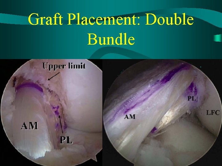 Graft Placement: Double Bundle 