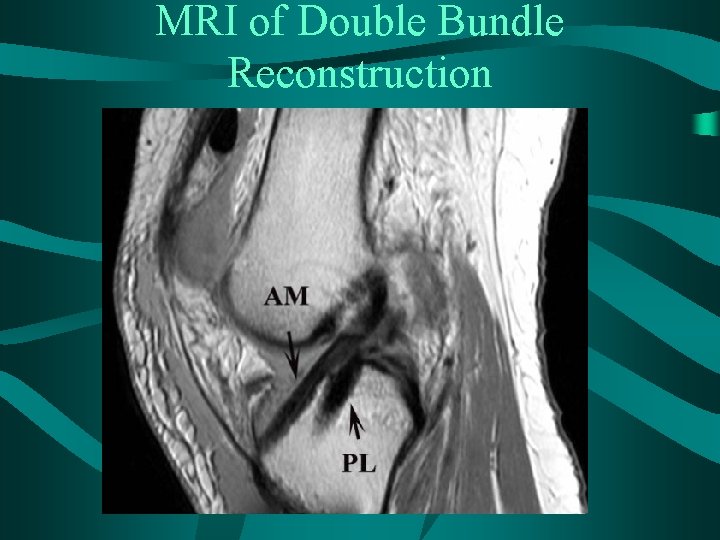 MRI of Double Bundle Reconstruction 