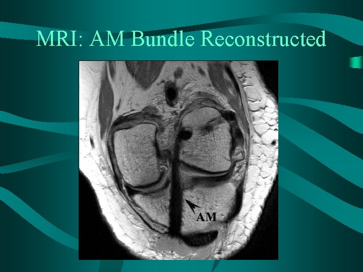 MRI: AM Bundle Reconstructed 