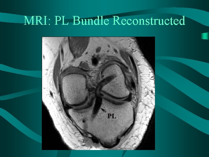 MRI: PL Bundle Reconstructed 
