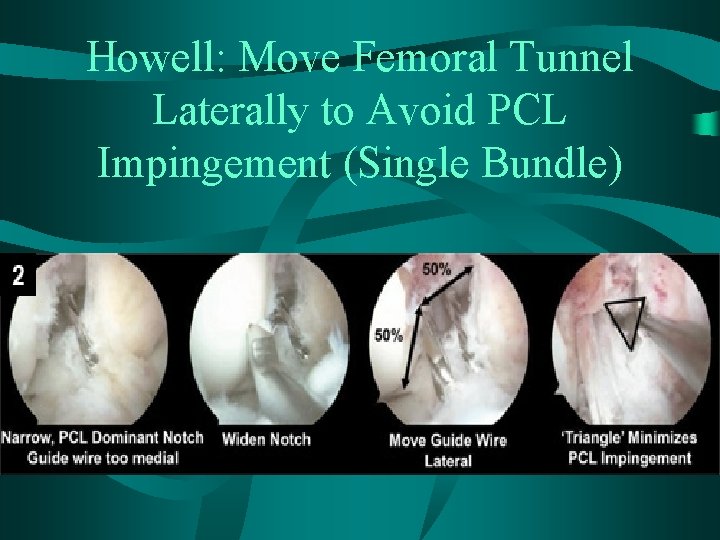 Howell: Move Femoral Tunnel Laterally to Avoid PCL Impingement (Single Bundle) 
