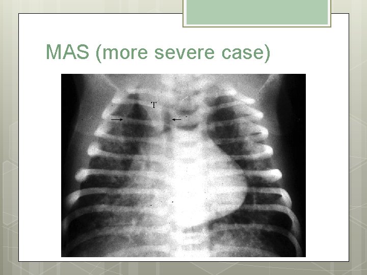 MAS (more severe case) 
