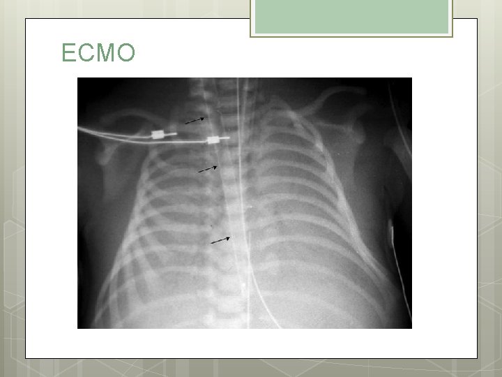 ECMO 