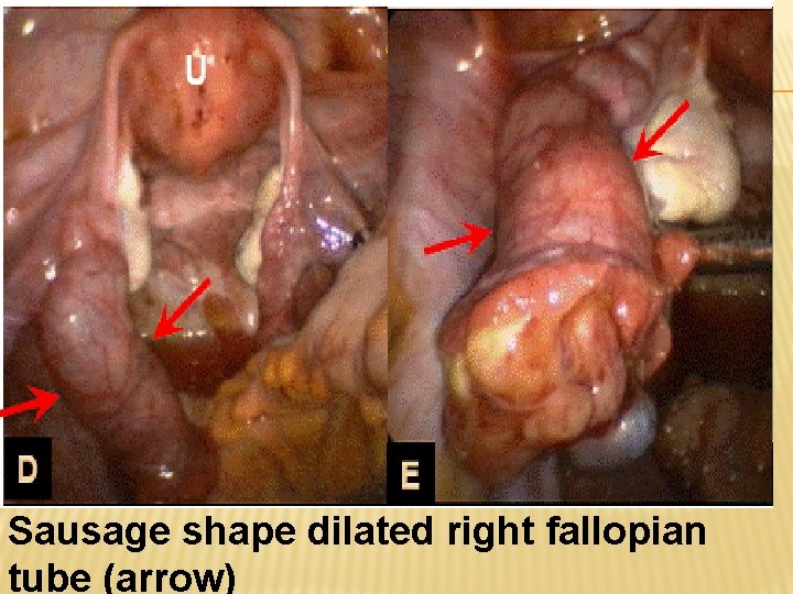 Sausage shape dilated right fallopian tube (arrow) 