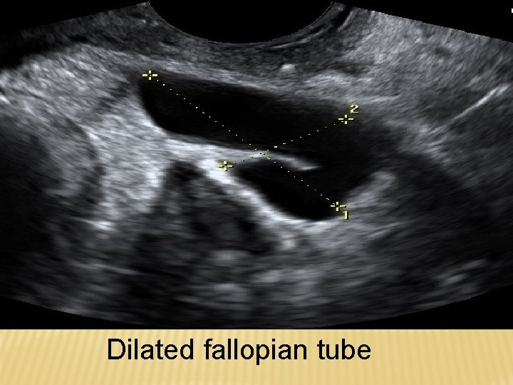 Dilated fallopian tube 