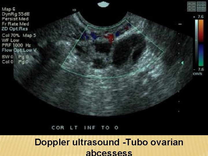 Doppler ultrasound -Tubo ovarian 