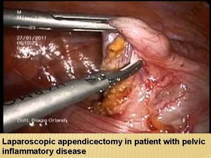 Laparoscopic appendicectomy in patient with pelvic inflammatory disease 