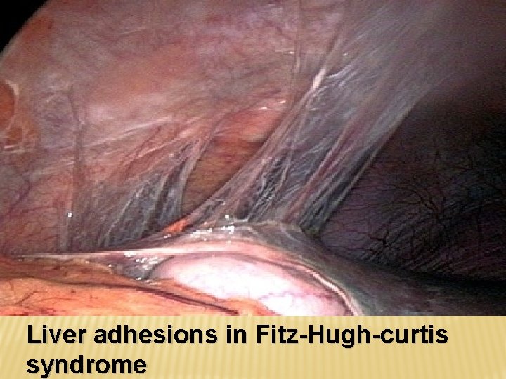 Liver adhesions in Fitz-Hugh-curtis syndrome 