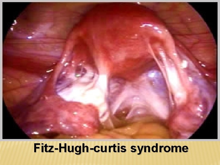 Fitz-Hugh-curtis syndrome 