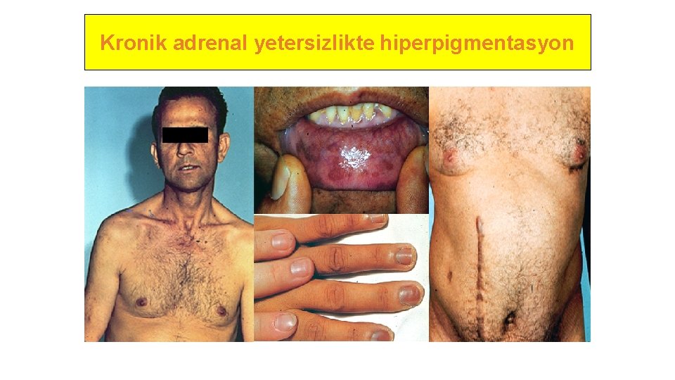 Kronik adrenal yetersizlikte hiperpigmentasyon 