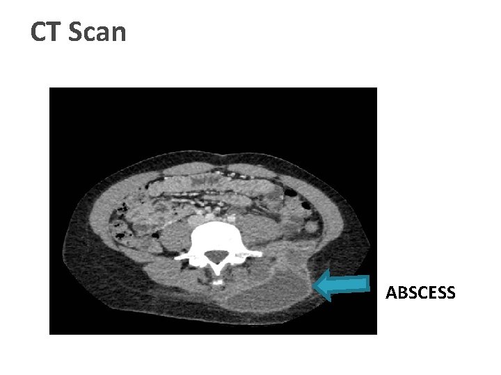 CT Scan ABSCESS 