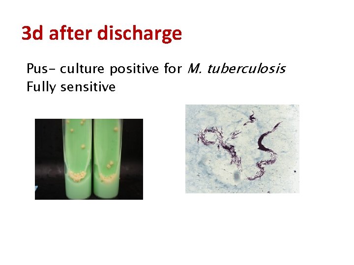 3 d after discharge Pus- culture positive for M. tuberculosis Fully sensitive 