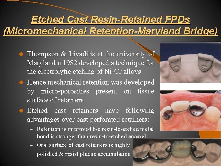 Etched Cast Resin-Retained FPDs (Micromechanical Retention-Maryland Bridge) Thompson & Livaditis at the university of
