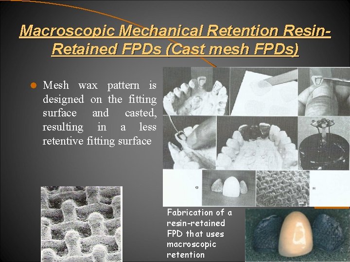 Macroscopic Mechanical Retention Resin. Retained FPDs (Cast mesh FPDs) l Mesh wax pattern is