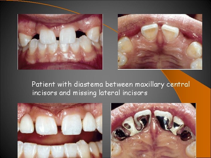 Patient with diastema between maxillary central incisors and missing lateral incisors 