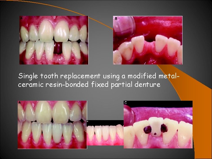 Single tooth replacement using a modified metalceramic resin-bonded fixed partial denture 