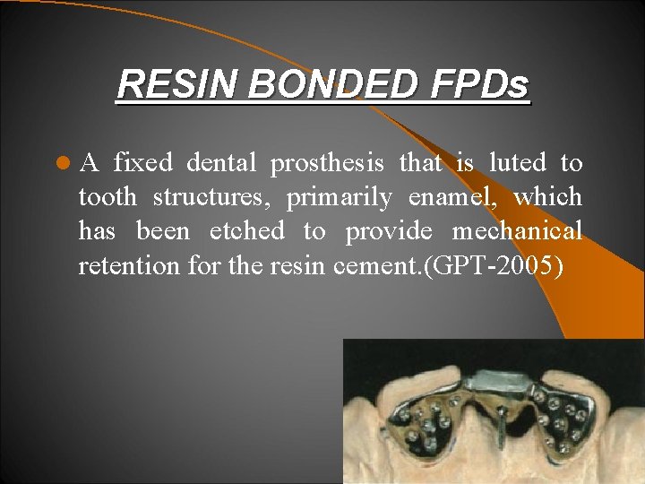 RESIN BONDED FPDs l. A fixed dental prosthesis that is luted to tooth structures,
