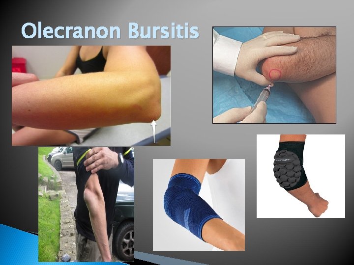 Olecranon Bursitis 