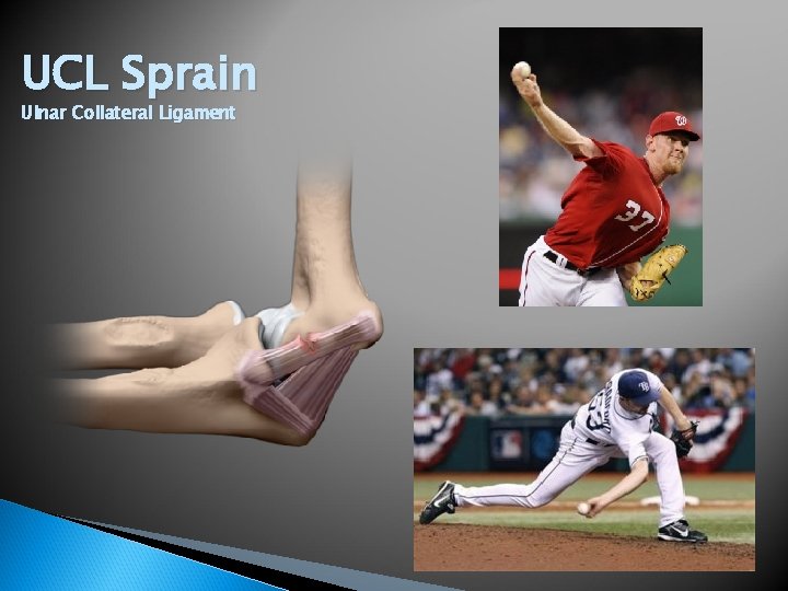 UCL Sprain Ulnar Collateral Ligament 