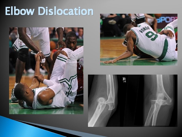 Elbow Dislocation 