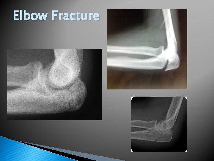 Elbow Fracture 