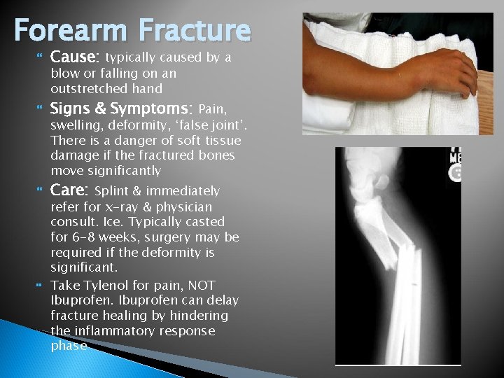 Forearm Fracture Cause: typically caused by a Signs & Symptoms: Pain, Care: Splint &