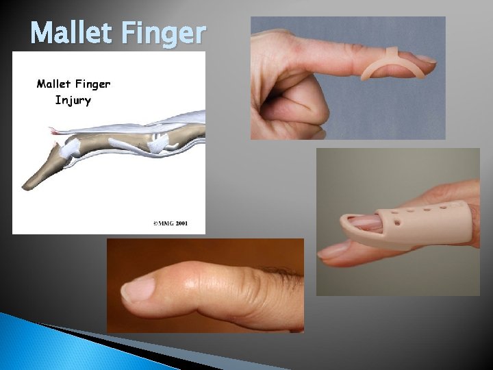 Mallet Finger 