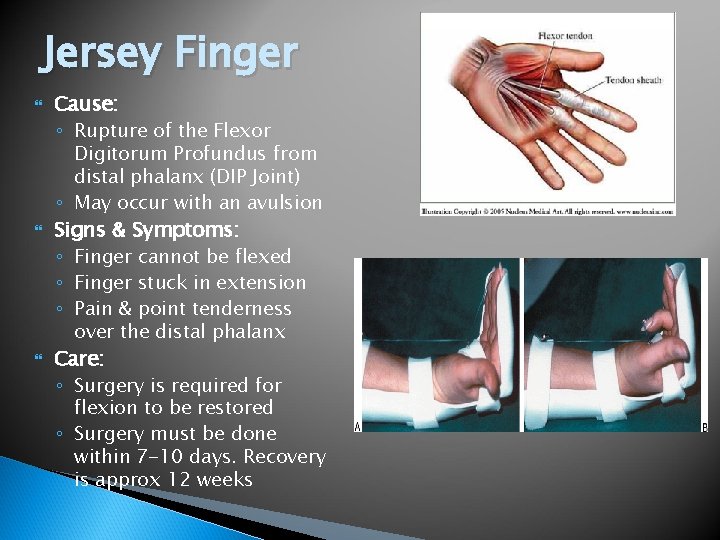Jersey Finger Cause: ◦ Rupture of the Flexor Digitorum Profundus from distal phalanx (DIP