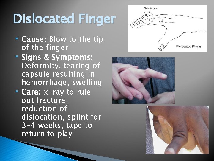 Dislocated Finger Cause: Blow to the tip of the finger Signs & Symptoms: Deformity,