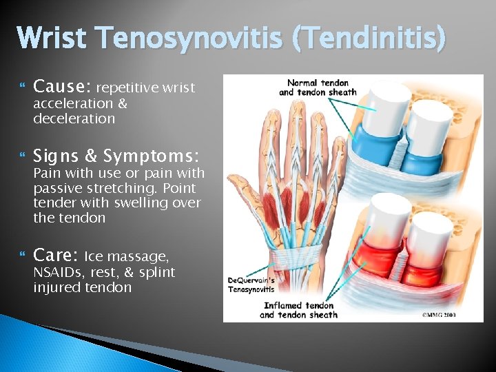 Wrist Tenosynovitis (Tendinitis) Cause: repetitive wrist Signs & Symptoms: Care: acceleration & deceleration Pain