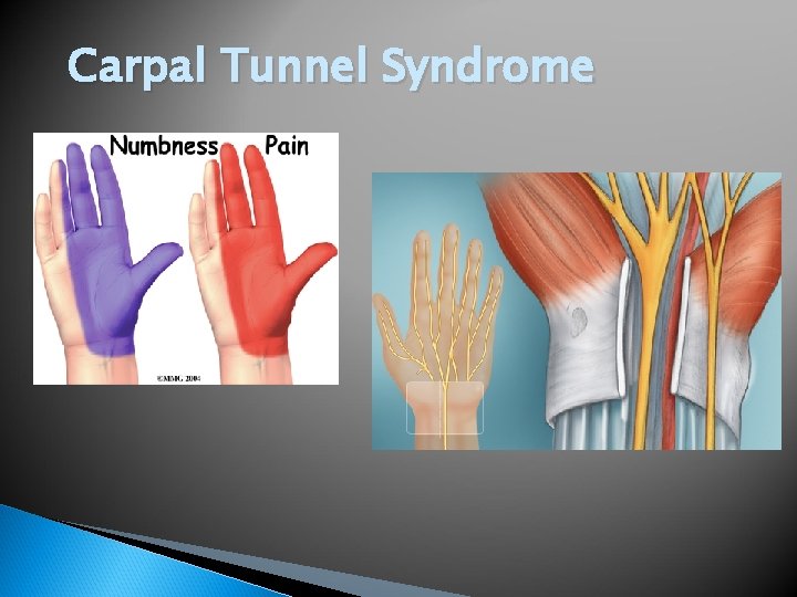 Carpal Tunnel Syndrome 