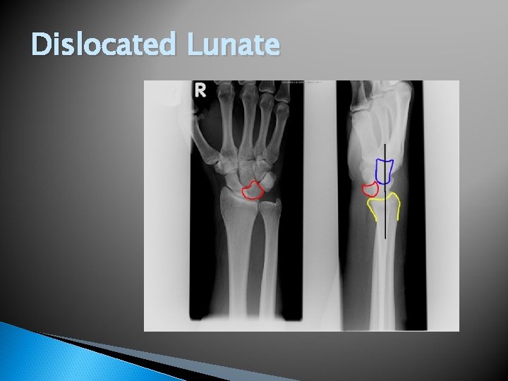 Dislocated Lunate 