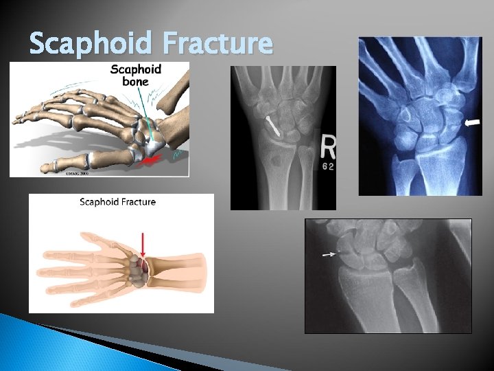 Scaphoid Fracture 