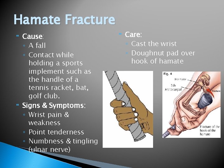 Hamate Fracture Cause: ◦ A fall ◦ Contact while holding a sports implement such
