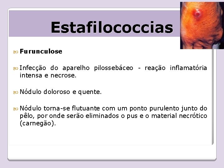 Estafilococcias Furunculose Infecção do aparelho pilossebáceo - reação inflamatória intensa e necrose. Nódulo doloroso