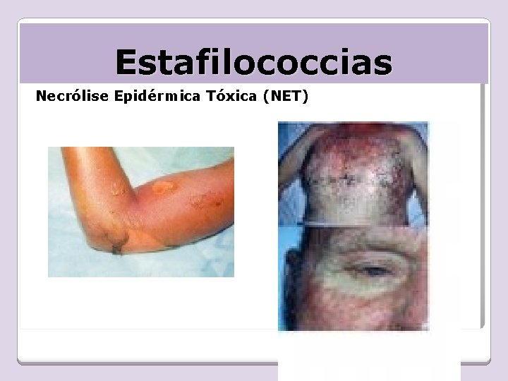 Estafilococcias Necrólise Epidérmica Tóxica (NET) 