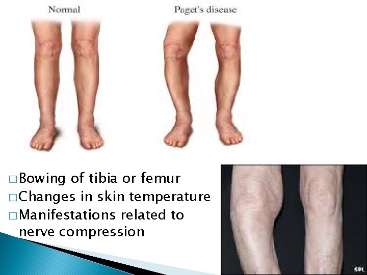 � Bowing of tibia or femur � Changes in skin temperature � Manifestations related