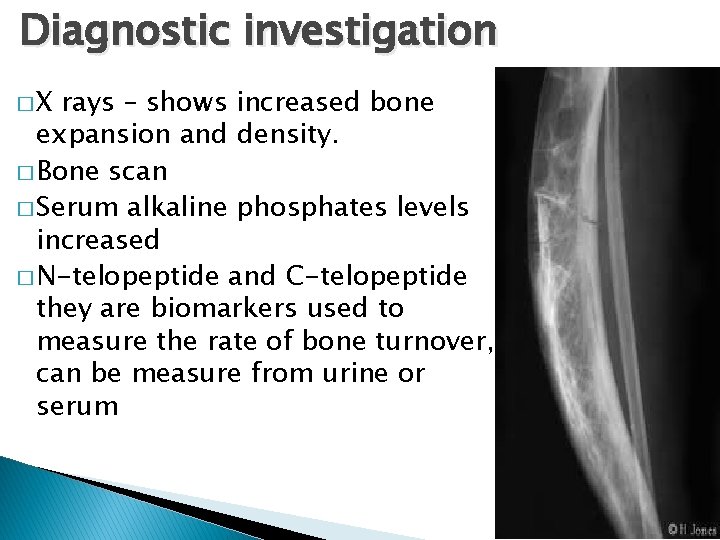 Diagnostic investigation �X rays – shows increased bone expansion and density. � Bone scan