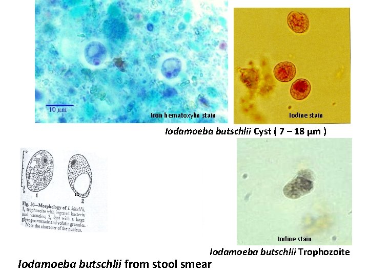 Iron hematoxylin stain Iodine stain Iodamoeba butschlii Cyst ( 7 – 18 µm )