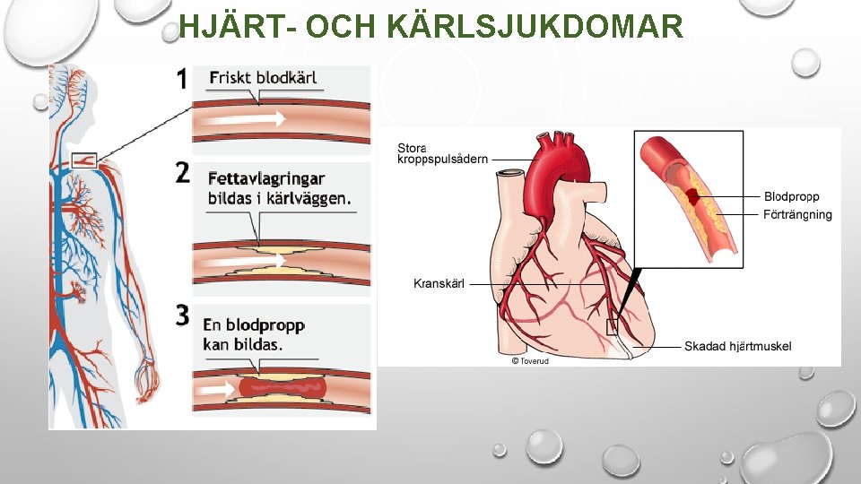 HJÄRT- OCH KÄRLSJUKDOMAR 