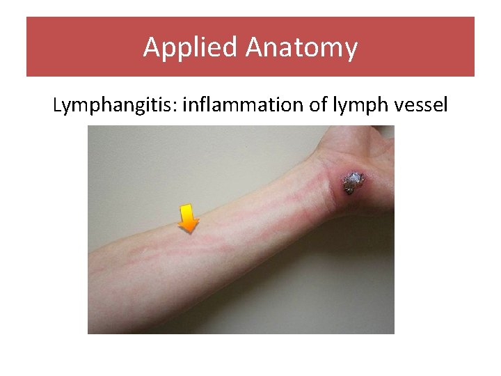 Applied Anatomy Lymphangitis: inflammation of lymph vessel 